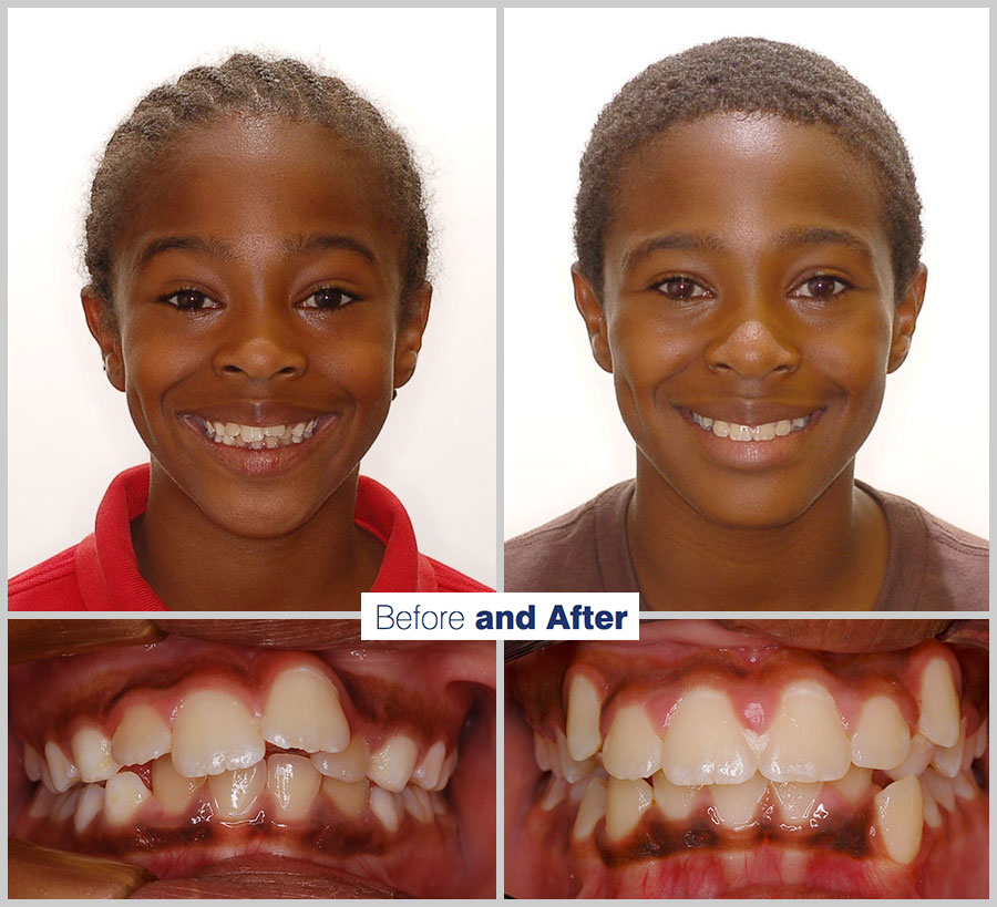 An image containing two headshots and two up close shots of the teeth, of a former PDS patient, displaying how much Orthodontic treatment can help.