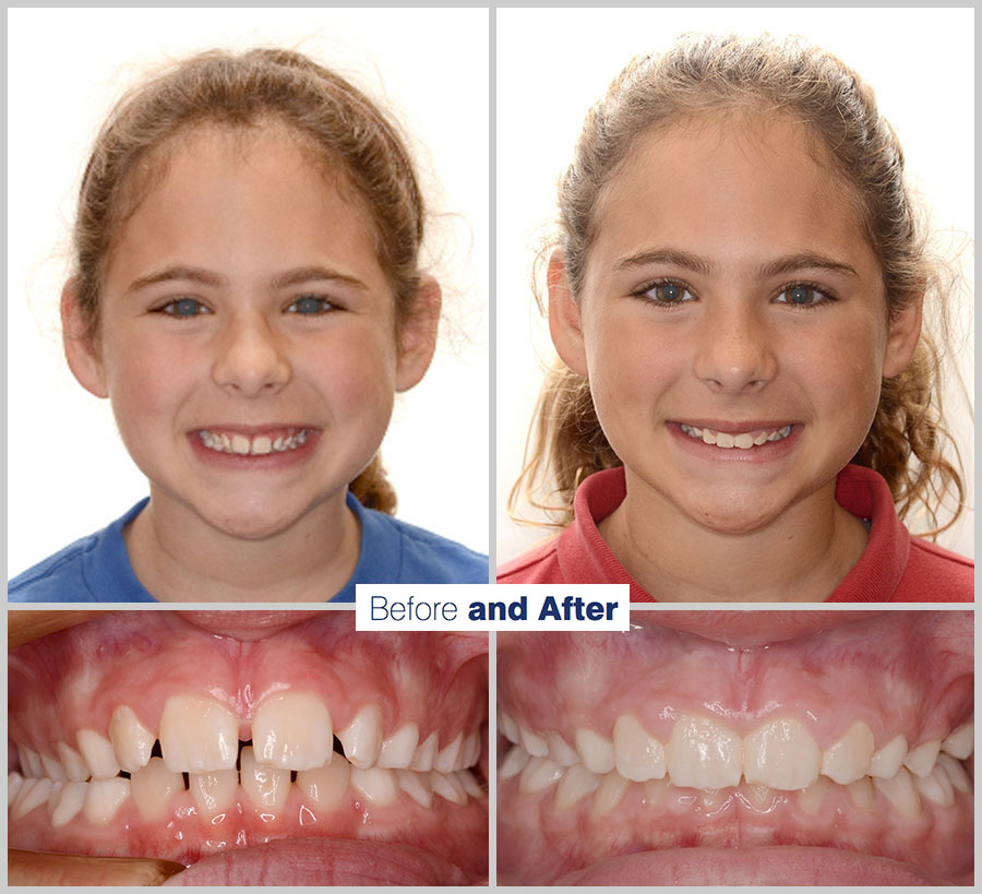 An image containing two headshots and two up close shots of the teeth, of a former PDS patient, displaying how much Orthodontic treatment can help.