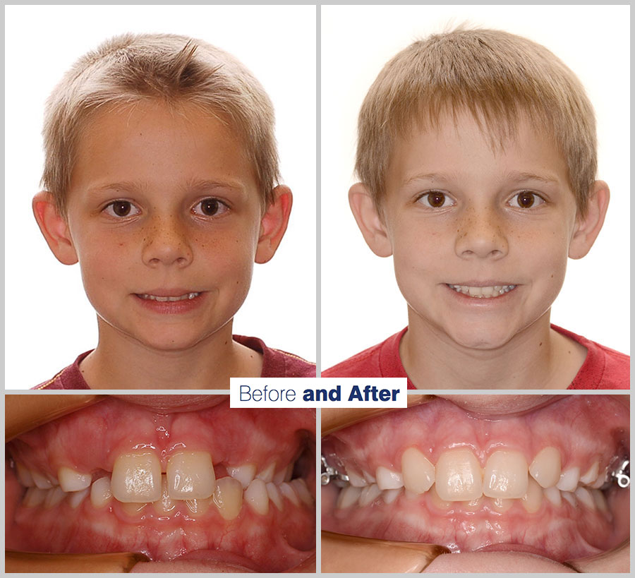 An image containing two headshots and two up close shots of the teeth, of a former PDS patient, displaying how much Orthodontic treatment can help.