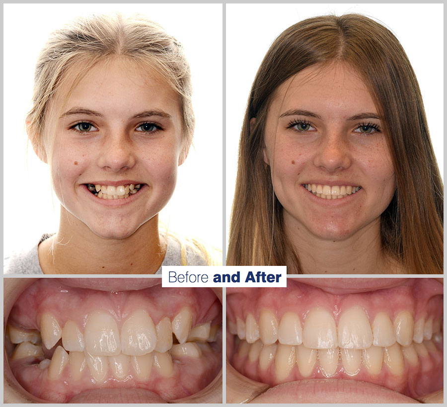 An image containing two headshots and two up close shots of the teeth, of a former PDS patient, displaying how much Orthodontic treatment can help.