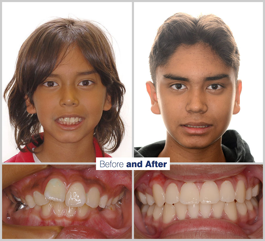 An image containing two headshots and two up close shots of the teeth, of a former PDS patient, displaying how much Orthodontic treatment can help.