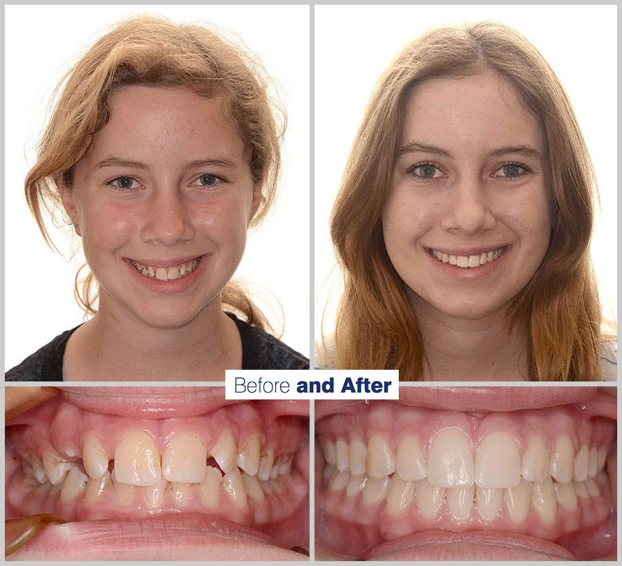 An image containing two headshots and two up close shots of the teeth, of a former PDS patient, displaying how much Orthodontic treatment can help.