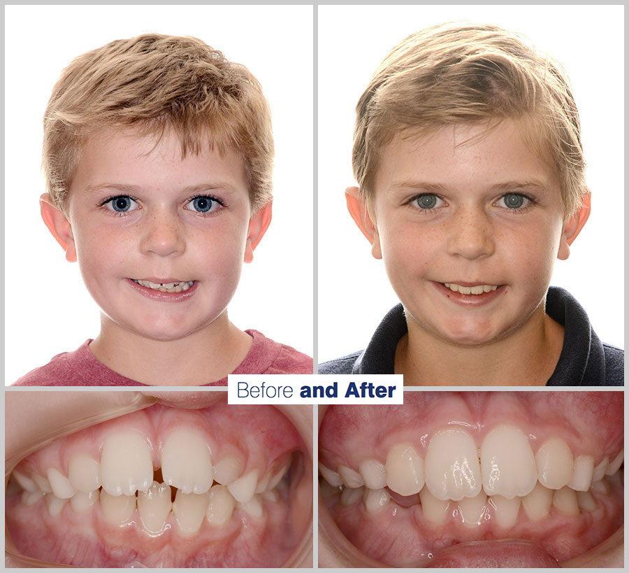 An image containing two headshots and two up close shots of the teeth, of a former PDS patient, displaying how much Orthodontic treatment can help.