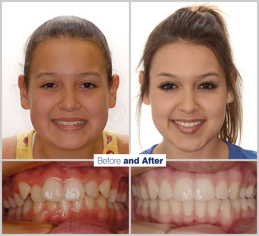 An image containing two headshots and two up close shots of the teeth, of a former PDS patient, displaying how much Orthodontic treatment can help.