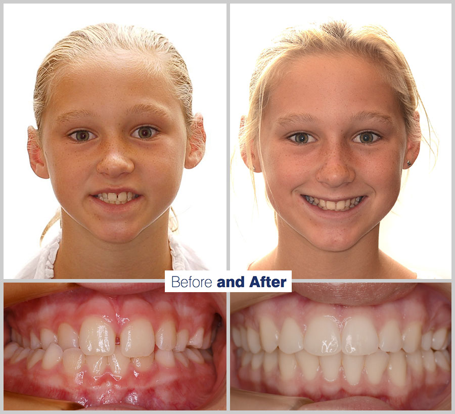 An image containing two headshots and two up close shots of the teeth, of a former PDS patient, displaying how much Orthodontic treatment can help.