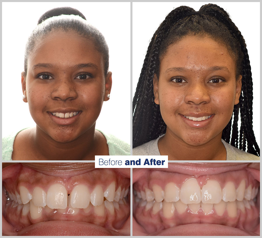 An image containing two headshots and two up close shots of the teeth, of a former PDS patient, displaying how much Orthodontic treatment can help.