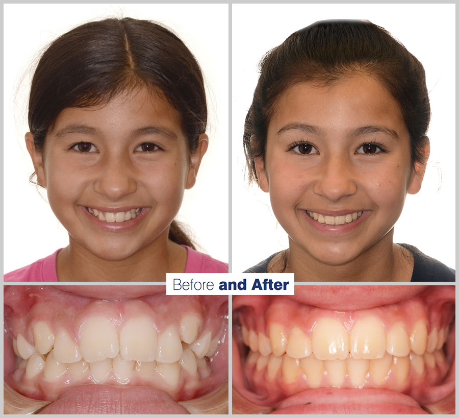 An image containing two headshots and two up close shots of the teeth, of a former PDS patient, displaying how much Orthodontic treatment can help.