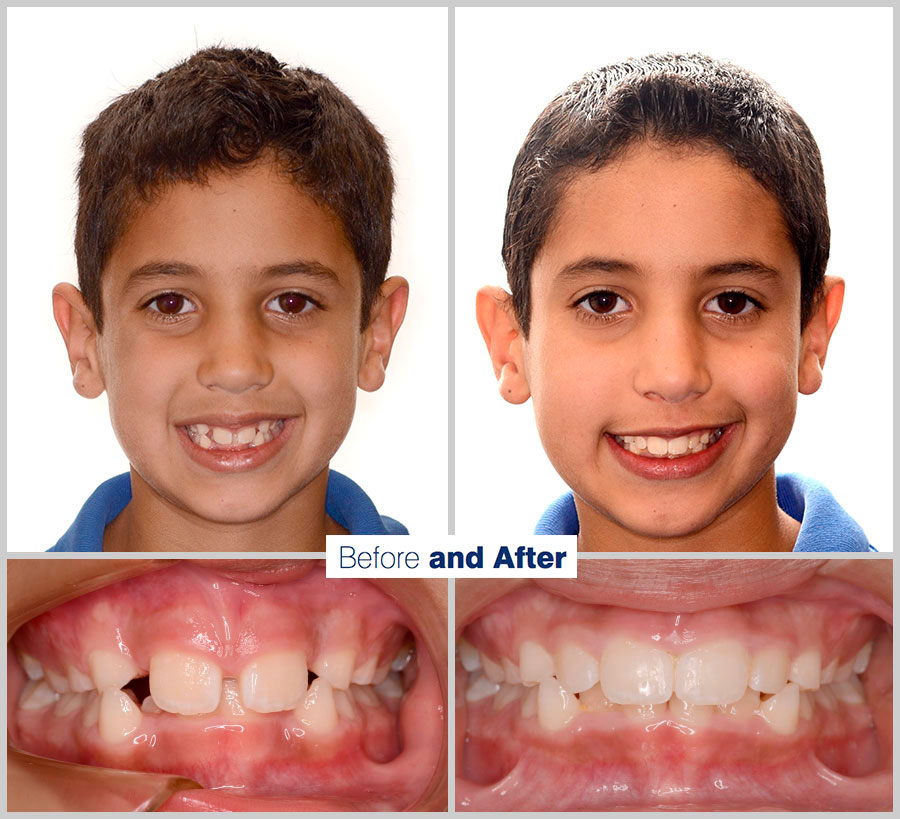 An image containing two headshots and two up close shots of the teeth, of a former PDS patient, displaying how much Orthodontic treatment can help.