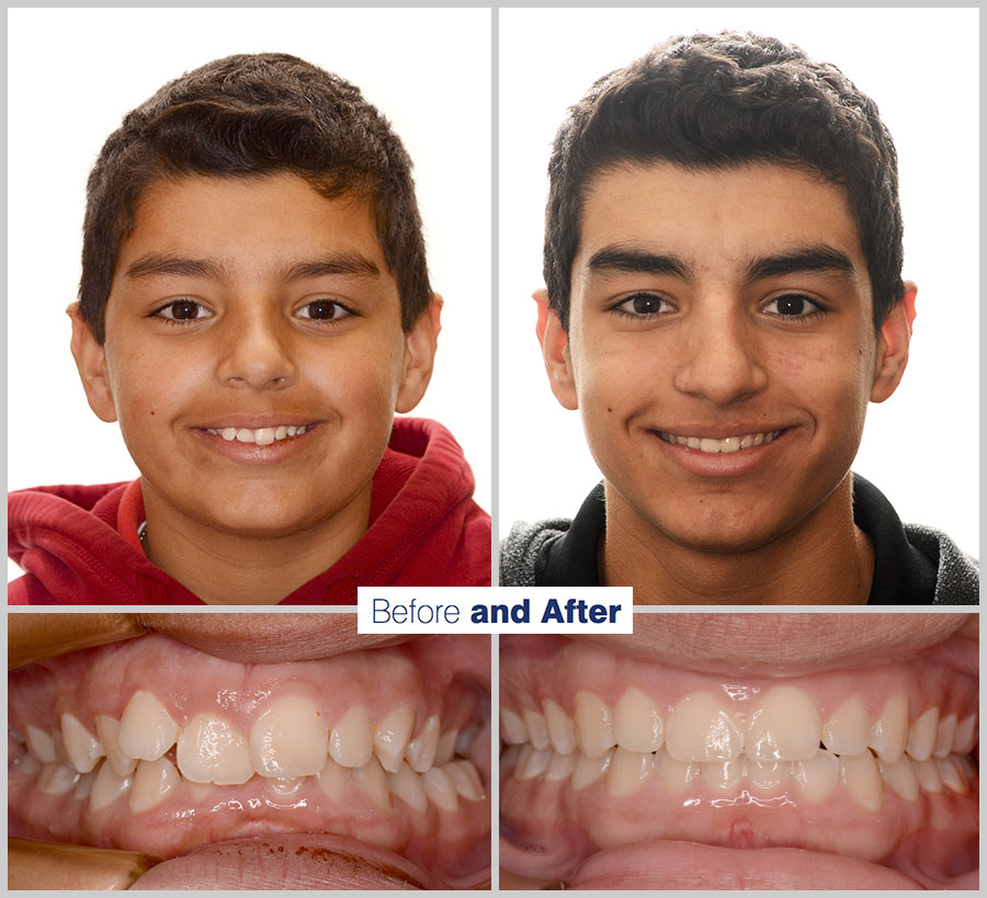 An image containing two headshots and two up close shots of the teeth, of a former PDS patient, displaying how much Orthodontic treatment can help.