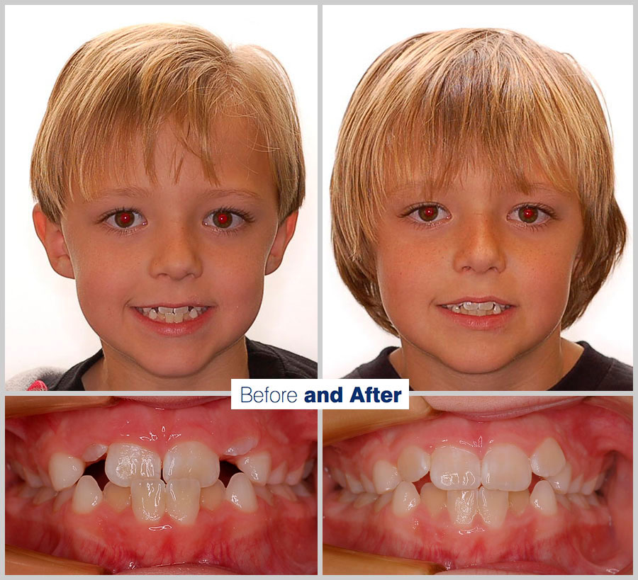 An image containing two headshots and two up close shots of the teeth, of a former PDS patient, displaying how much Orthodontic treatment can help.