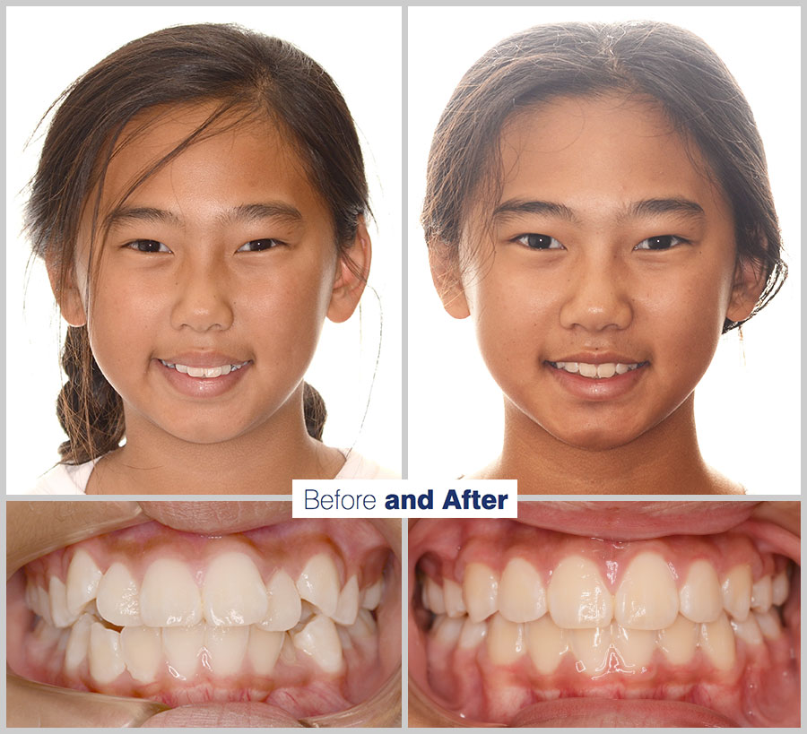 An image containing two headshots and two up close shots of the teeth, of a former PDS patient, displaying how much Orthodontic treatment can help.