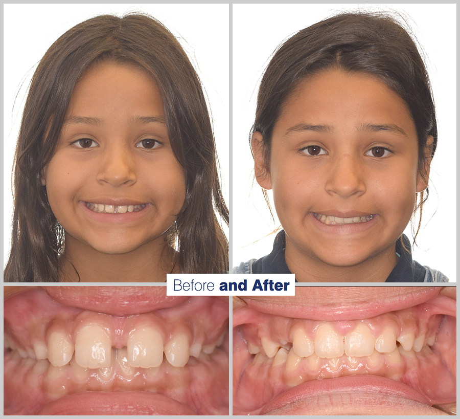 An image containing two headshots and two up close shots of the teeth, of a former PDS patient, displaying how much Orthodontic treatment can help.