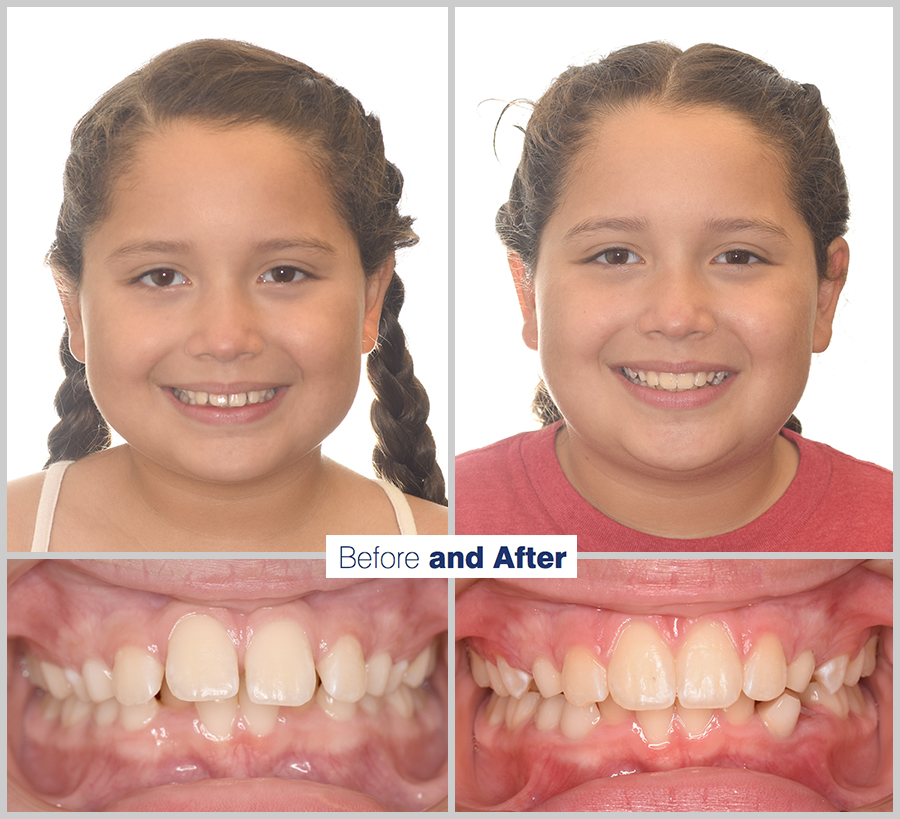 An image containing two headshots and two up close shots of the teeth, of a former PDS patient, displaying how much Orthodontic treatment can help.