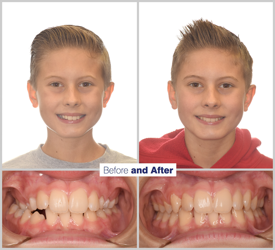 An image containing two headshots and two up close shots of the teeth, of a former PDS patient, displaying how much Orthodontic treatment can help.