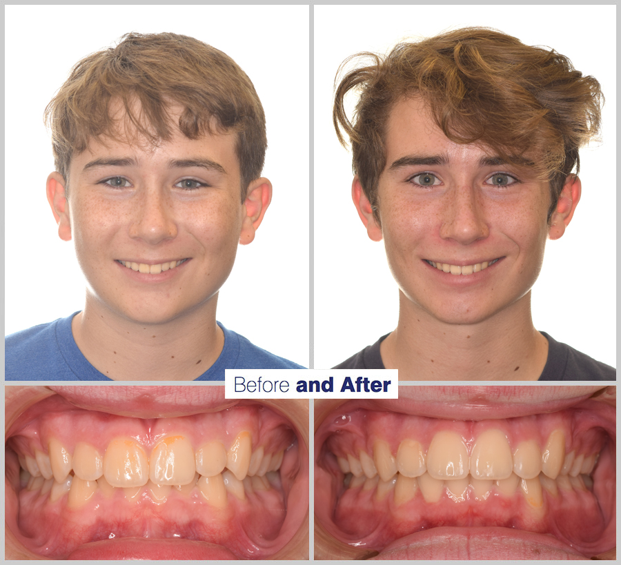 An image containing two headshots and two up close shots of the teeth, of a former PDS patient, displaying how much Orthodontic treatment can help.