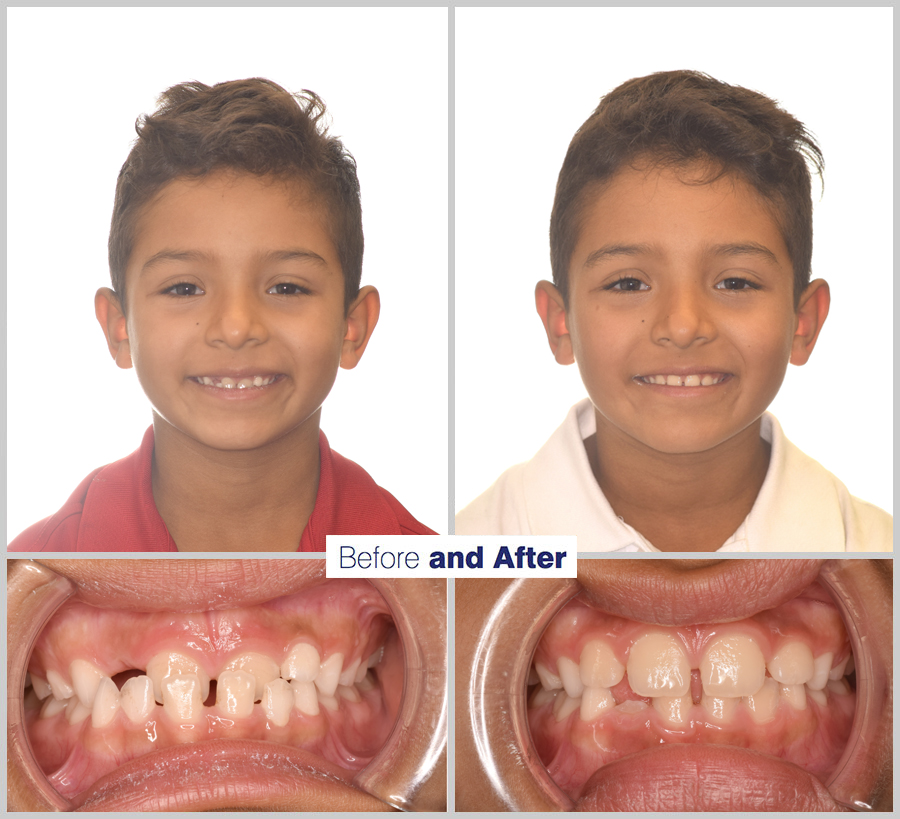 An image containing two headshots and two up close shots of the teeth, of a former PDS patient, displaying how much Orthodontic treatment can help.