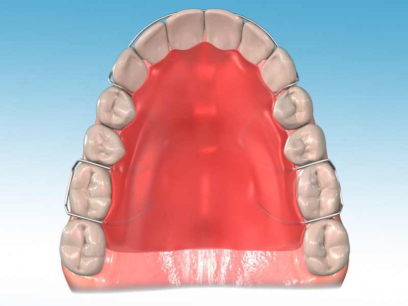An animation of a retainer