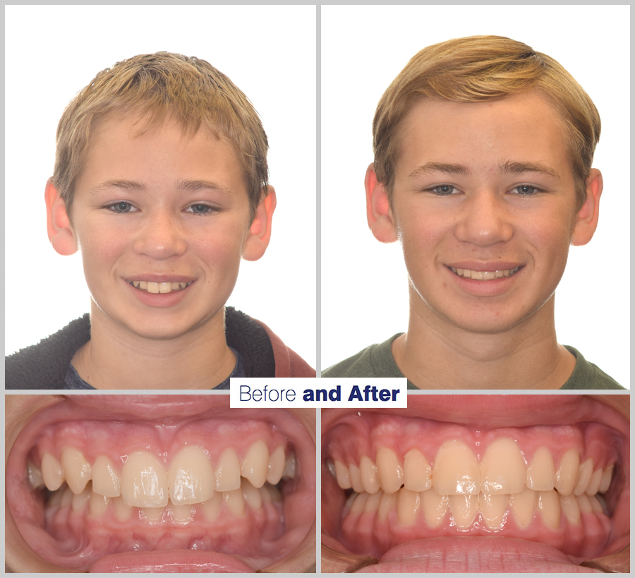 An image containing two headshots and two up close shots of the teeth, of a former PDS patient, displaying how much Orthodontic treatment can help.