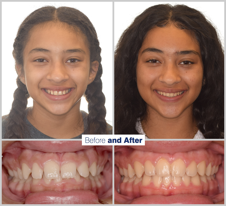 An image containing two headshots and two up close shots of the teeth, of a former PDS patient, displaying how much Orthodontic treatment can help.