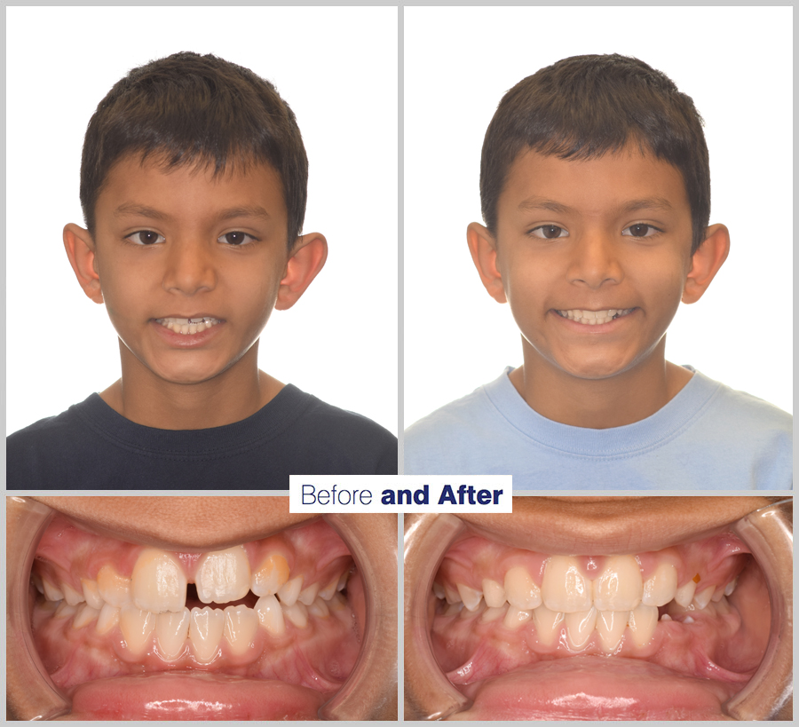 An image containing two headshots and two up close shots of the teeth, of a former PDS patient, displaying how much Orthodontic treatment can help.